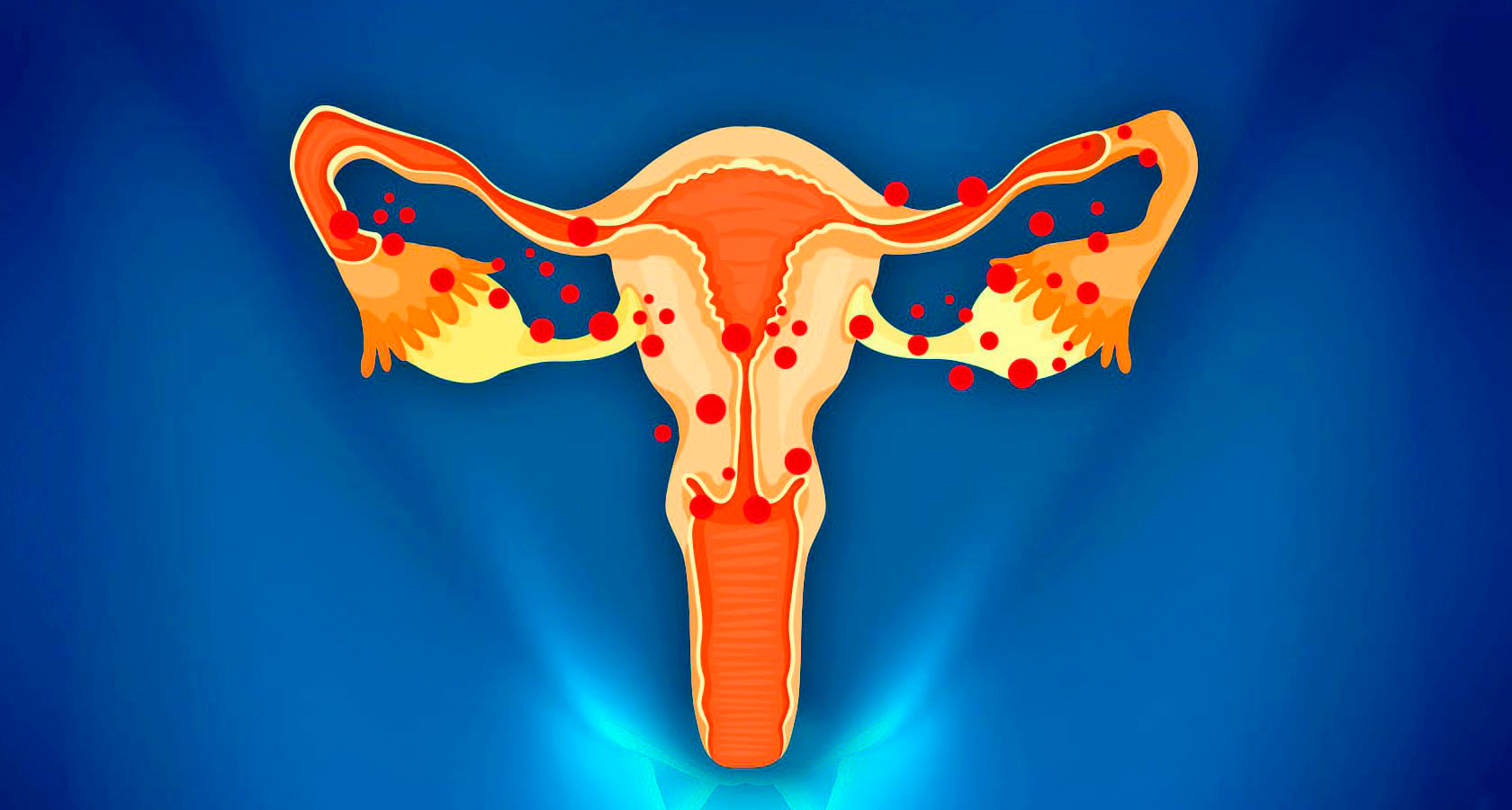 Endometriosis of the uterus